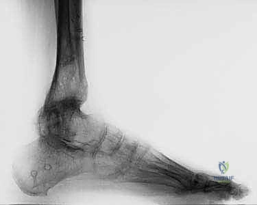 Minimally Invasive Percutaneous Osteotomy for Ankle Malunion with Gradual External Fixation: An Intraoperative Masterclass