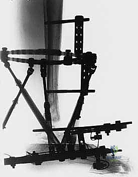 تصحيح سوء التئام الكاحل بالتدخل الجراحي المحدود والتثبيت الخارجي التدريجي: حلول متقدمة للأستاذ الدكتور محمد هطيف