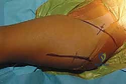 فتح الكبسولة المفصلية