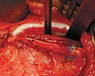 صورة توضيحية لـ الخلع الوركي التطوري (DDH) عند الأطفال: دليل شامل للنهج الأمامي للرد المفتوح مع الأستاذ الدكتور محمد هطيف