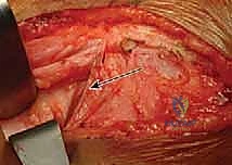 إغلاق الجرح بدقة تجميلية