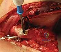 الدكتور محمد هطيف أثناء إجراء تدخل جراحي دقيق لخلع الورك