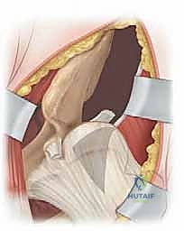 توضيح تشريحي لمسار النهج الأمامي