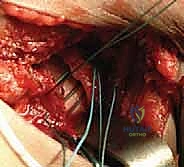 تحرير العضلة القطنية