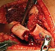Illustration of developmentally dislocated hip - Dr. Mohammed Hutaif