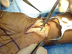 توضيح أسباب متلازمة النفق الرسغي