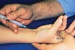 تحرير النفق الرسغي: دليل شامل للمرضى مع الأستاذ الدكتور محمد هطيف في صنعاء