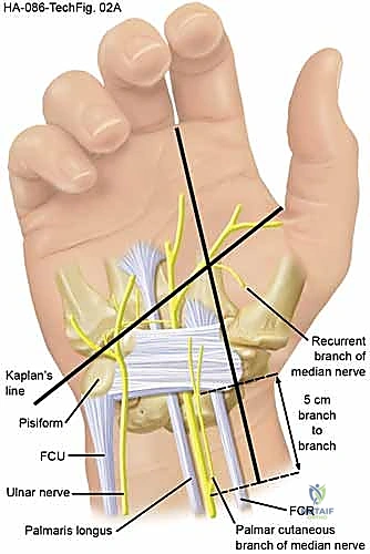 صورة توضيحية لـ تحرير النفق الرسغي: دليل شامل للمرضى مع الأستاذ الدكتور محمد هطيف في صنعاء