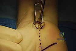 صورة توضح مناطق الألم والتنميل