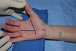 صورة توضيحية لـ تحرير النفق الرسغي: دليل شامل للمرضى مع الأستاذ الدكتور محمد هطيف في صنعاء