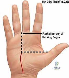 صورة توضيحية لـ تحرير النفق الرسغي: دليل شامل للمرضى مع الأستاذ الدكتور محمد هطيف في صنعاء