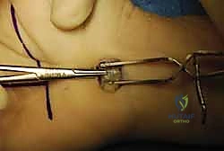 الفحص السريري للنفق الرسغي