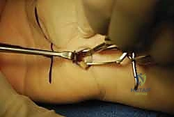 توضيح تشريحي للنفق الرسغي