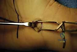 صورة توضيحية لـ تحرير النفق الرسغي: دليل شامل للمرضى مع الأستاذ الدكتور محمد هطيف في صنعاء