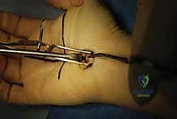 تخطيط الأعصاب والتشخيص