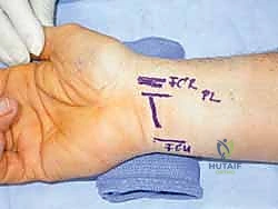 صورة طبية: تحرير النفق الرسغي: دليل شامل للمرضى مع الأستاذ الدكتور محمد هطيف في صنعاء