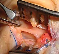 تجبير الرسغ والعلاج التحفظي
