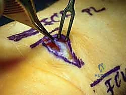 صورة توضيحية لـ تحرير النفق الرسغي: دليل شامل للمرضى مع الأستاذ الدكتور محمد هطيف في صنعاء