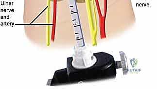 صورة طبية: تحرير النفق الرسغي: دليل شامل للمرضى مع الأستاذ الدكتور محمد هطيف في صنعاء