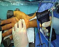 صورة توضيحية لـ تحرير النفق الرسغي: دليل شامل للمرضى مع الأستاذ الدكتور محمد هطيف في صنعاء