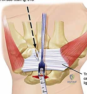 صورة طبية: تحرير النفق الرسغي: دليل شامل للمرضى مع الأستاذ الدكتور محمد هطيف في صنعاء