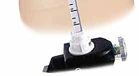 صورة طبية: تحرير النفق الرسغي: دليل شامل للمرضى مع الأستاذ الدكتور محمد هطيف في صنعاء