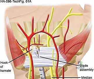 صورة طبية: تحرير النفق الرسغي: دليل شامل للمرضى مع الأستاذ الدكتور محمد هطيف في صنعاء