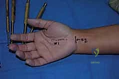 صورة طبية: تحرير النفق الرسغي: دليل شامل للمرضى مع الأستاذ الدكتور محمد هطيف في صنعاء