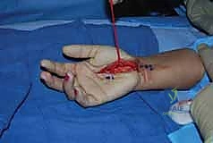 صورة طبية: تحرير النفق الرسغي: دليل شامل للمرضى مع الأستاذ الدكتور محمد هطيف في صنعاء