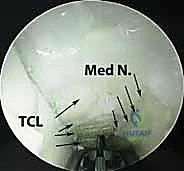 صورة طبية: تحرير النفق الرسغي: دليل شامل للمرضى مع الأستاذ الدكتور محمد هطيف في صنعاء
