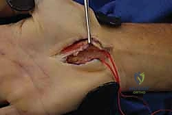 صورة توضيحية لـ تحرير النفق الرسغي: دليل شامل للمرضى مع الأستاذ الدكتور محمد هطيف في صنعاء