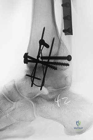 التخطيط الجراحي لترميم الكاحل