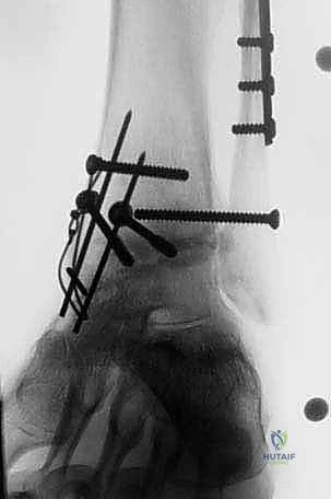 الاستعانة بالمناظير الدقيقة أثناء الجراحة