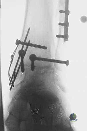 توضيح التشريح الدقيق لمفصل الكاحل