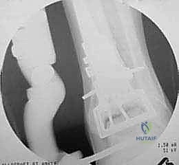 تجهيز الطعم العظمي الغضروفي