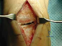 تقييم حالة الغضروف قبل الجراحة