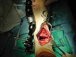 ترميم مفصل الكاحل الشامل بالطعوم العظمية الغضروفية: حل متقدم لخشونة الكاحل