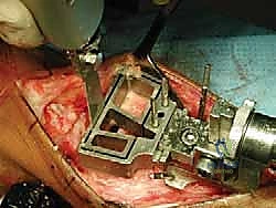 تشكيل الطعم الغضروفي ليتطابق مع المفصل