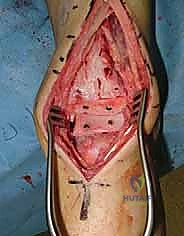 خطوات التثبيت النهائي للطعوم