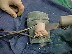 إزالة الأنسجة التالفة من الكاحل