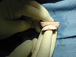 إدخال الطعم الغضروفي في مكانه الدقيق