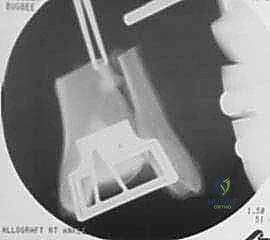 التثبيت المؤقت للطعم