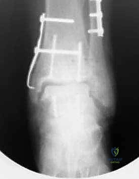 النتيجة النهائية للسطح المفصلي