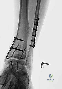 Comprehensive Total Ankle Osteochondral Shell Allograft Reconstruction: An Intraoperative Masterclass
