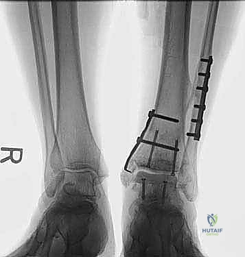 Intraoperative Surgical Step