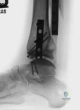 إغلاق الشق الجراحي العظمي