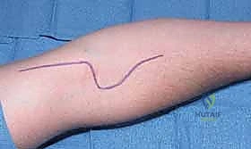 Median Nerve Decompression: Mastering Pronator and Anterior Interosseous Syndromes