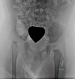 الفحص السريري وعلامات خلع الورك التطوري