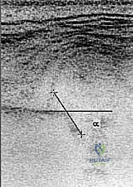 Medial Open Reduction of Developmental Hip Dislocation: An Intraoperative Masterclass