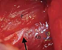 فتح الكبسولة المفصلية للورك